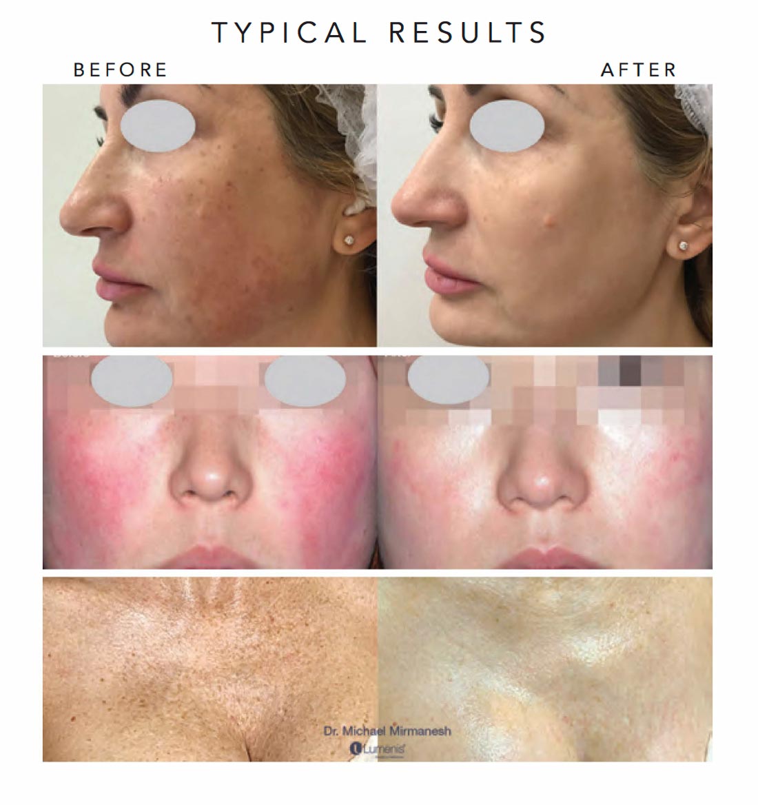 fractional laser treatment before and after photos